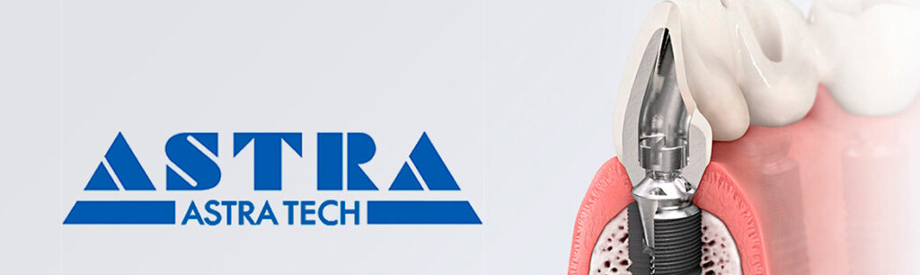 Чем уникальны импланты Astra Tech