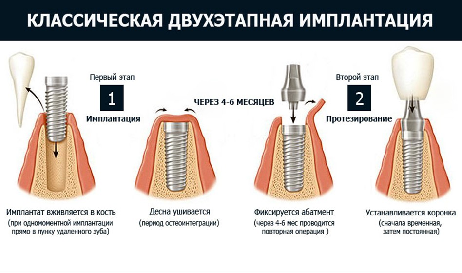 Методы дентальной имплантации